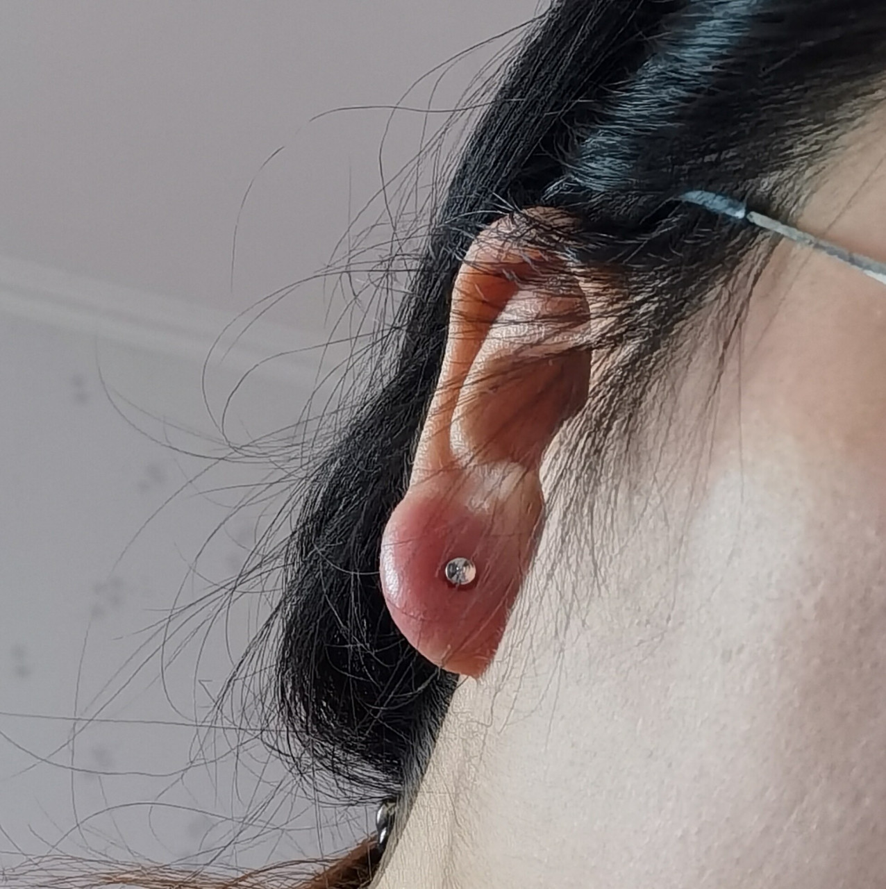 这才打耳洞第三天 左边这只红肿热痛是不是要发炎了 果然臭美都是要