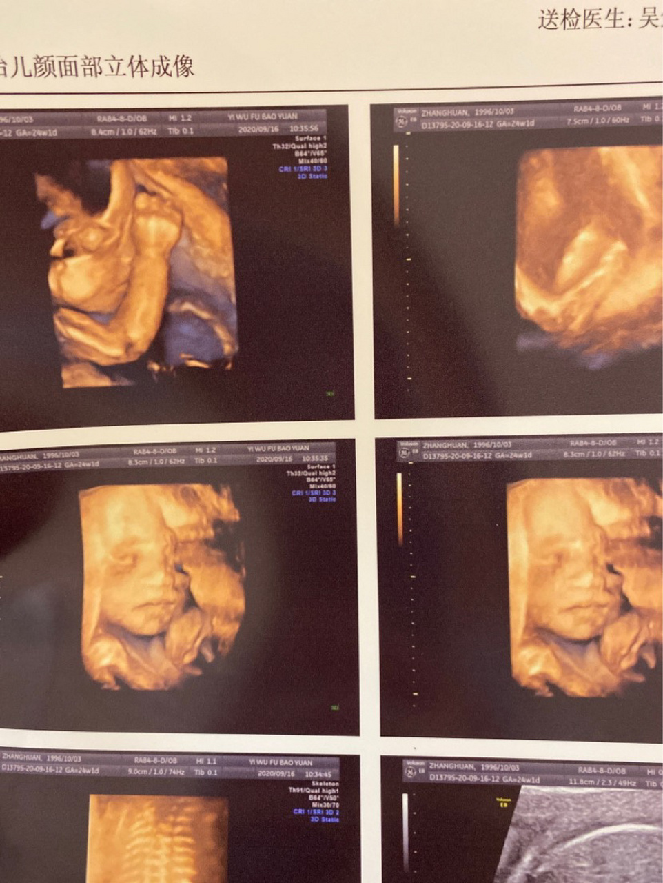 新鲜出炉的四维图,有没有姐妹会看男女 第一胎,作为老母亲真的太好奇