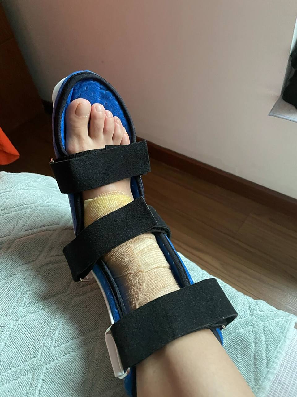 脚踝软组织肿胀第三天 8月8日晚在白云山(惠凮亭)不慎扭到脚,不到一