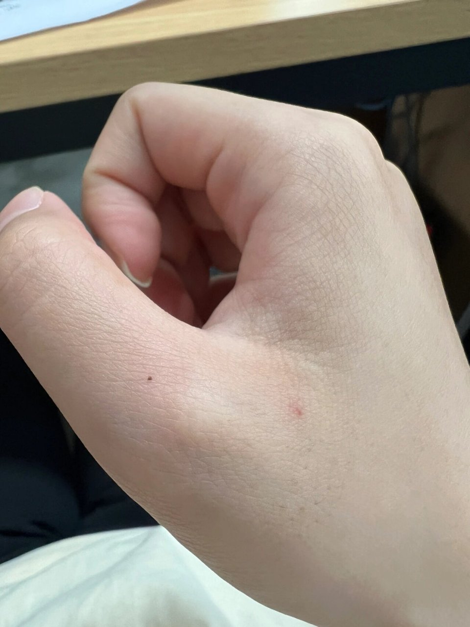 前两天突然发现自己大拇指上多了一颗小黑痣,我还以为是脏东西或者是