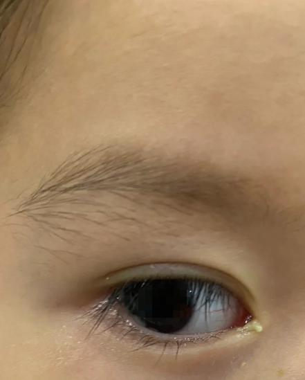 为什么眼睛老是有眼屎