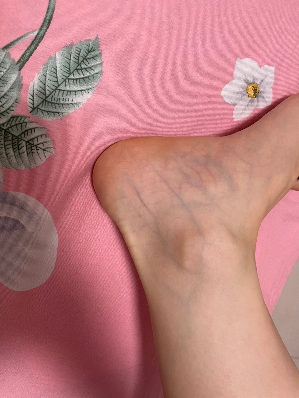 小腿血管明显是怎么回事