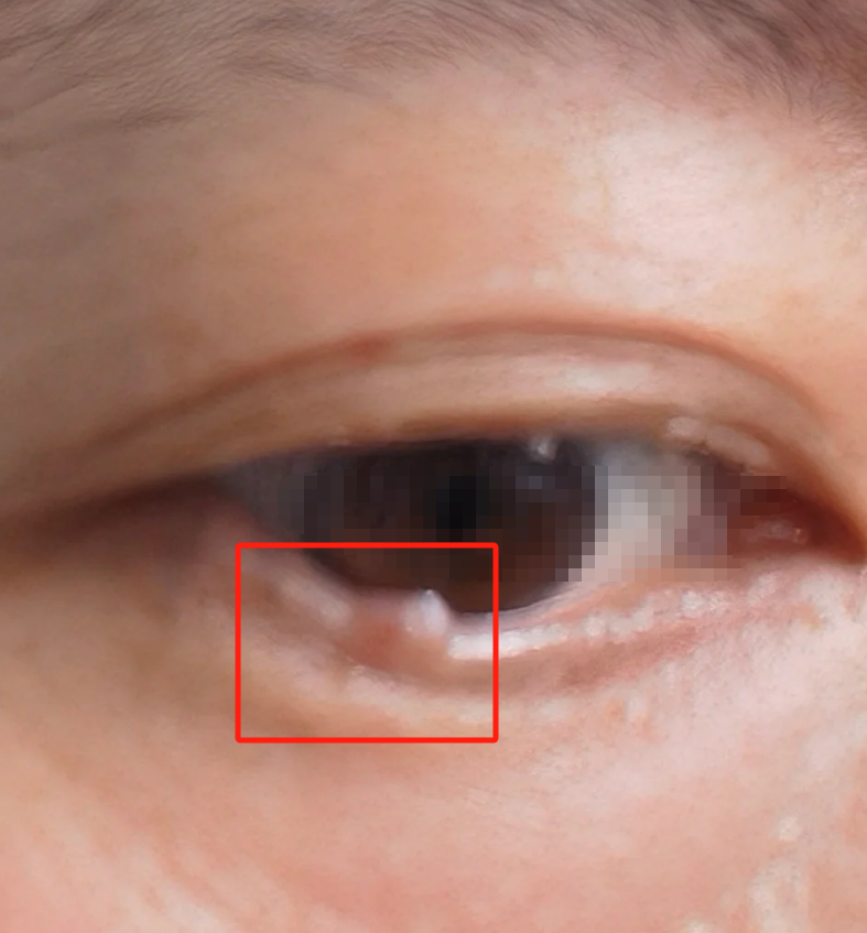 这是沙眼衣原体感染结膜上皮引起的