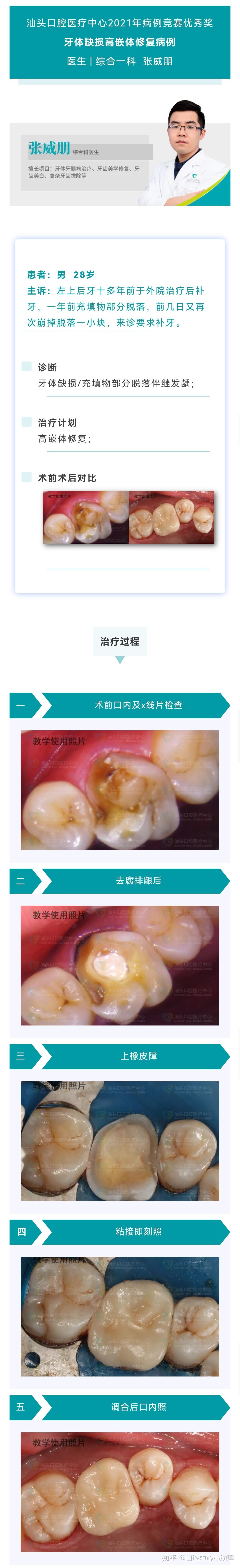 蛀牙缺损比较大嵌体修复了解一下
