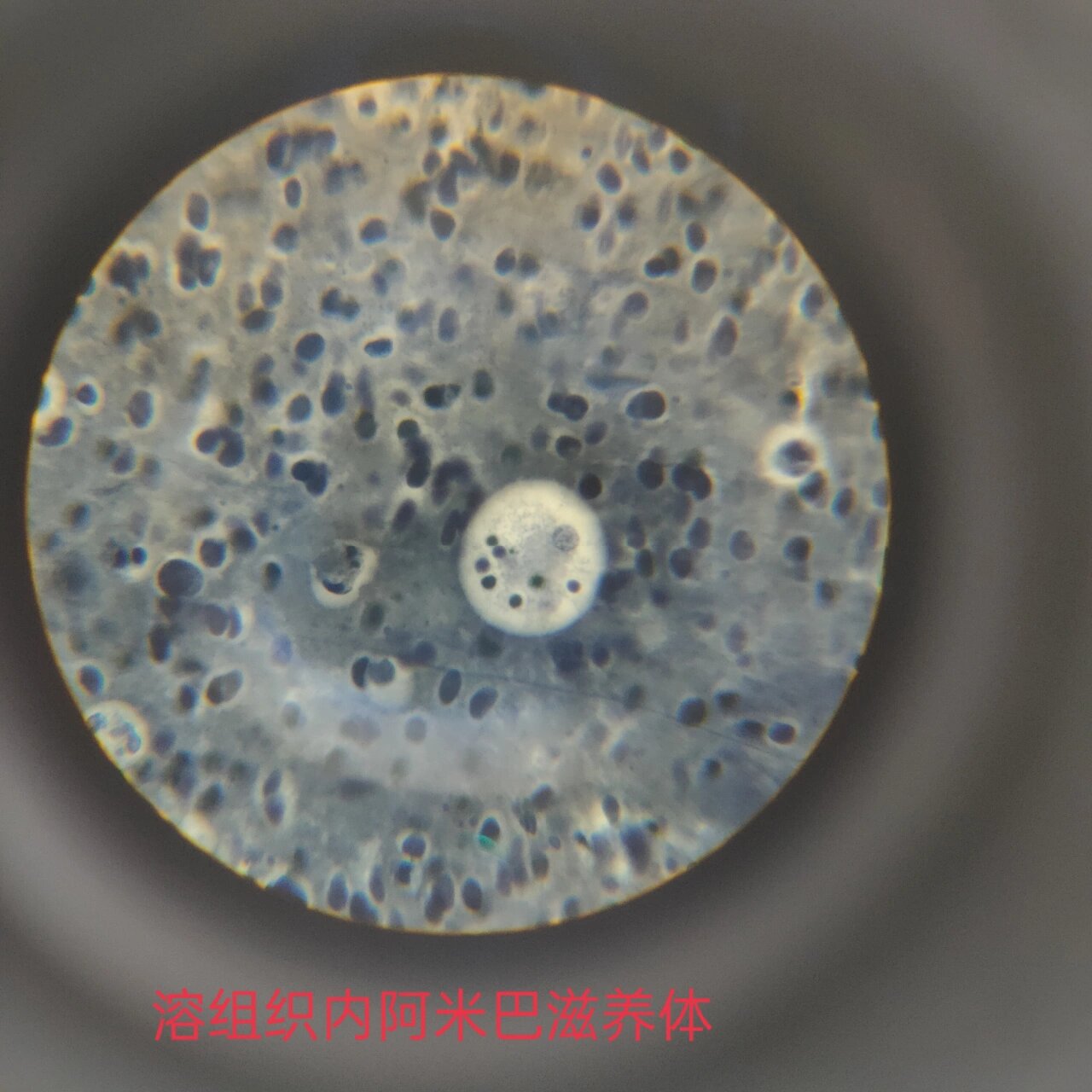 医学原虫镜下观察 ①溶组织内阿米巴包囊 (感染期为四核包囊,二分裂)