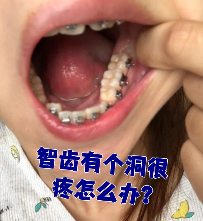坏了一个洞是补还是拔掉被智齿顶坏的牙齿图片智齿坏掉智齿有个窟窿