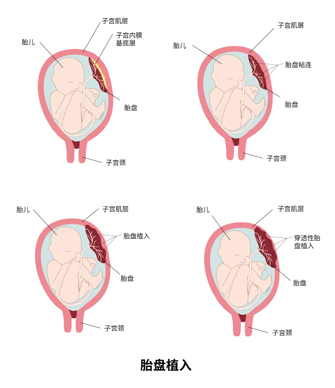 子宫后壁胎盘图图片