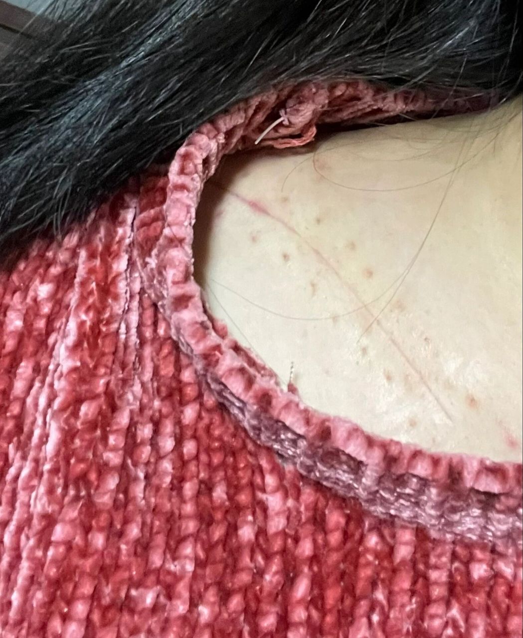 我的祛疤之旅 左锁骨骨折术后一个月,今天开始贴美皮护了,期待会有好