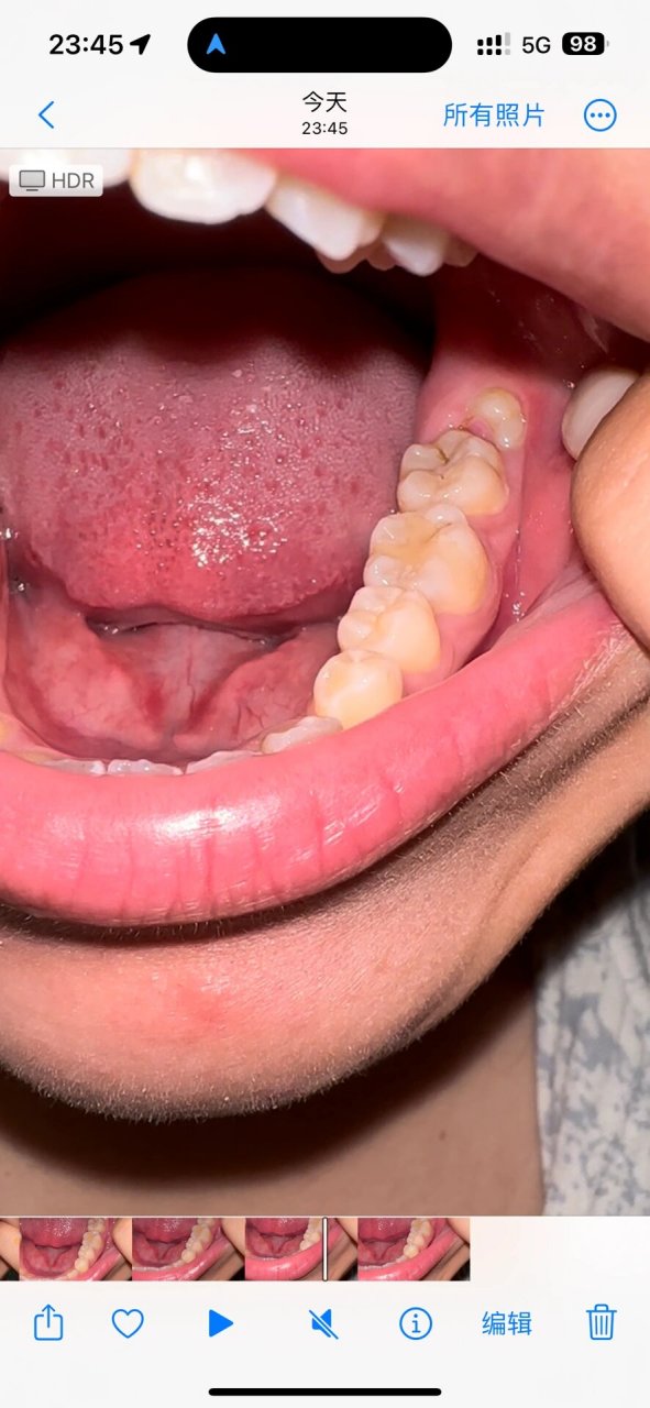 智齿前有块小肉会疼 长智齿了 前面有个坑容易有食物残渣 这两天吃