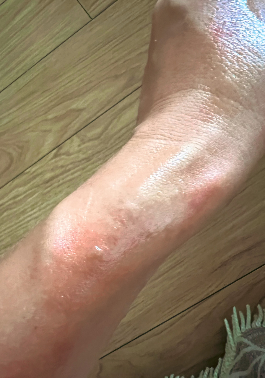 顺便给大家科普一下:1,一度烫伤:一般及时用清水冲洗,无需特殊处理