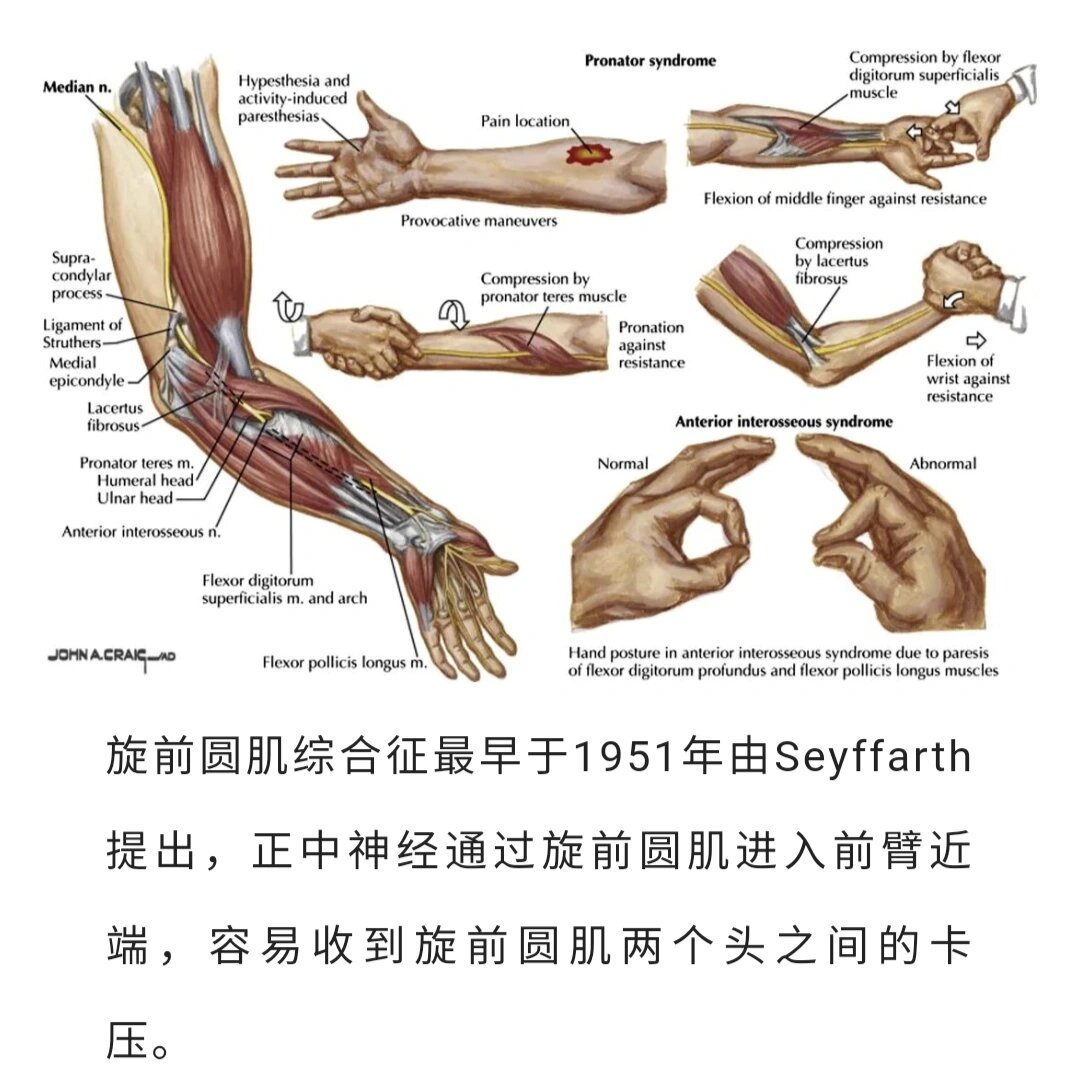 旋前圆肌综合征