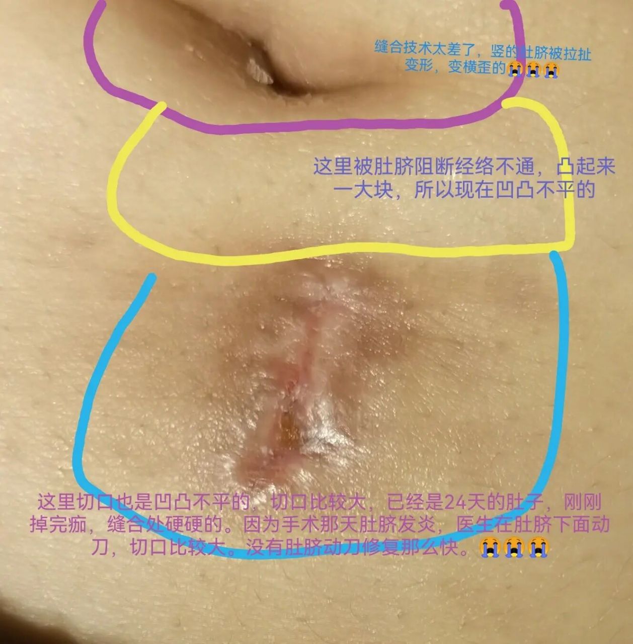 腹腔镜胆囊切除手术事项. 1.