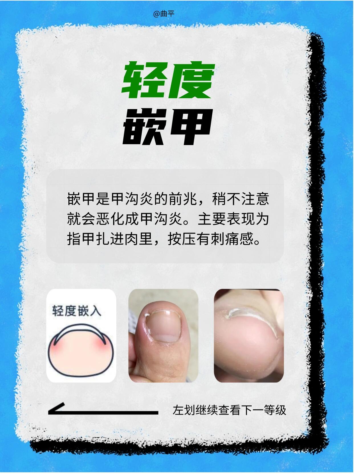 一分钟自查你的甲沟炎在哪级(内附应对方法) 指甲本来是为了保护手指