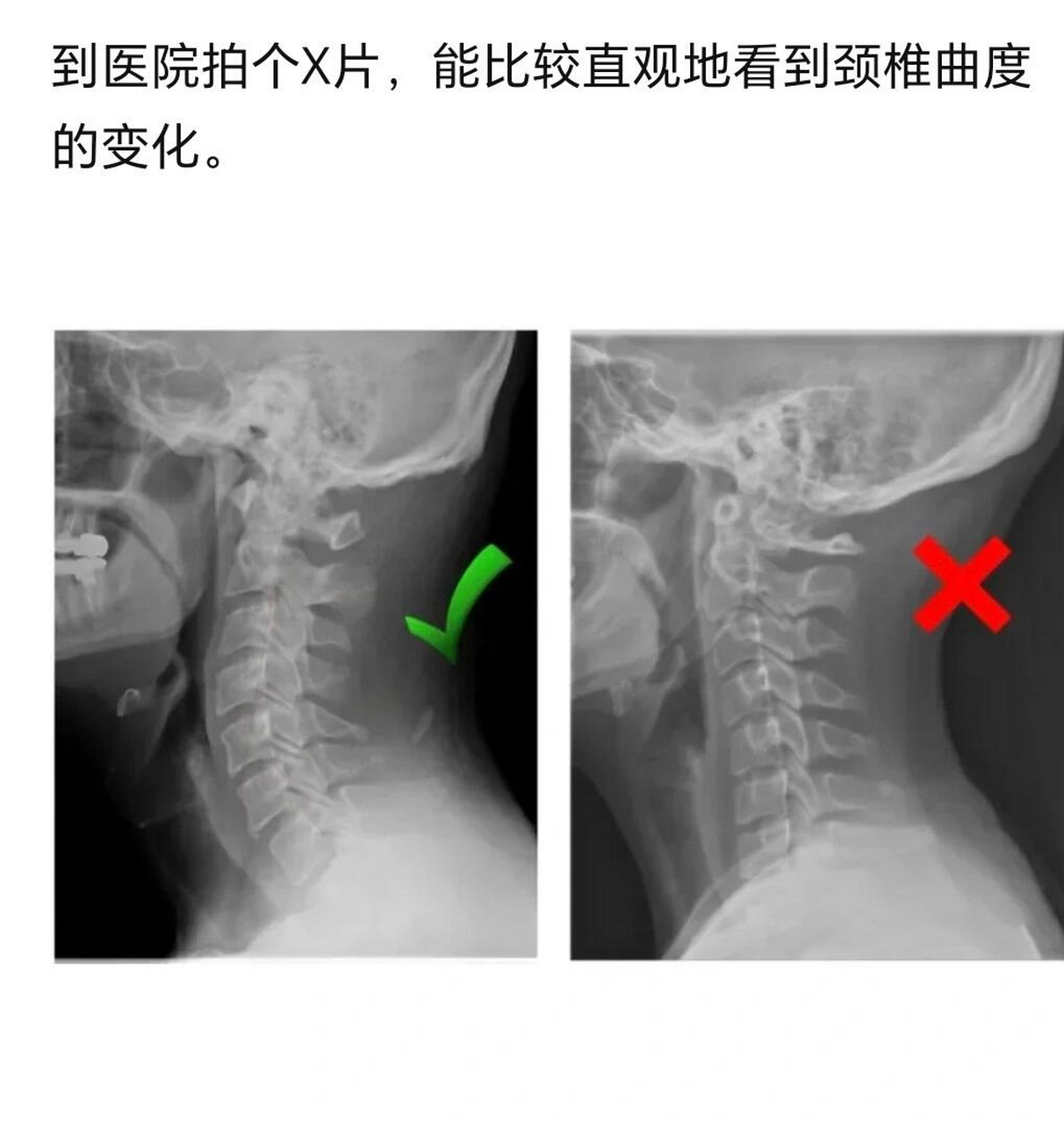 颈椎第五节滑脱图片图片