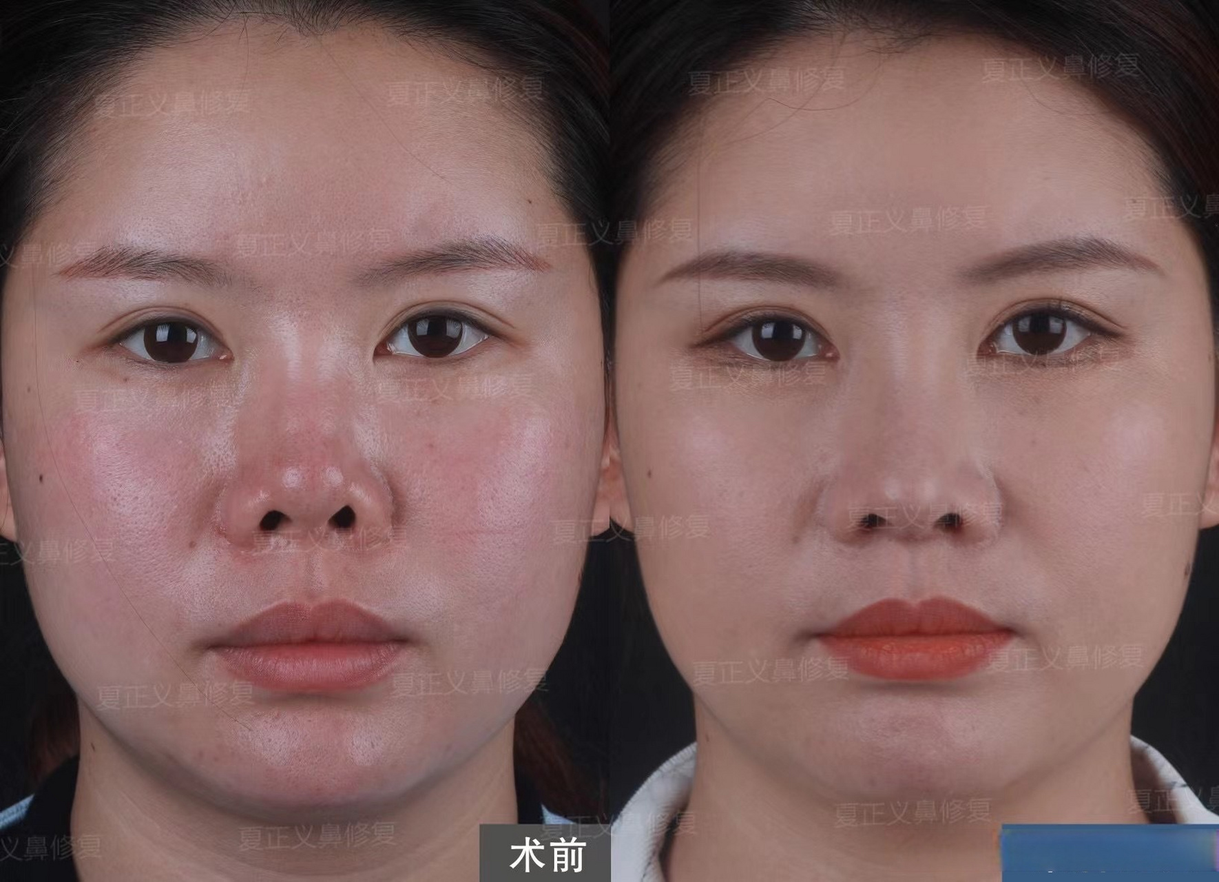 【挛缩鼻修复】 正面漏鼻孔,朝天短鼻,形态怪异,重新搭建鼻部结构