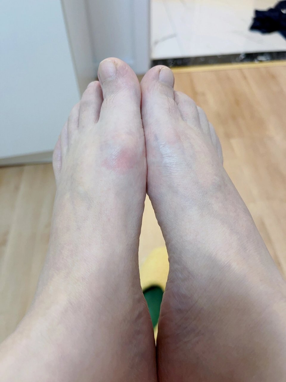 不吃药就500以上01 这几天降温了,又开始红肿疼,痛风脚一定要注意