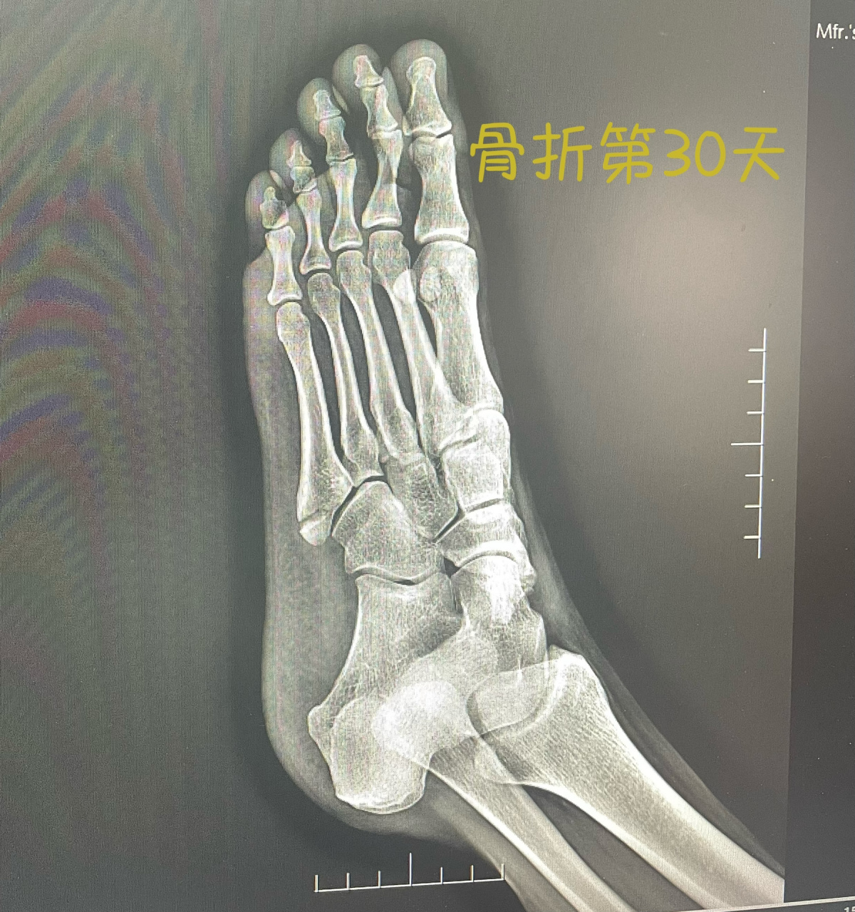第五跖骨骨折1个月 从2月13到3.14,骨折30天了,满一个月了.