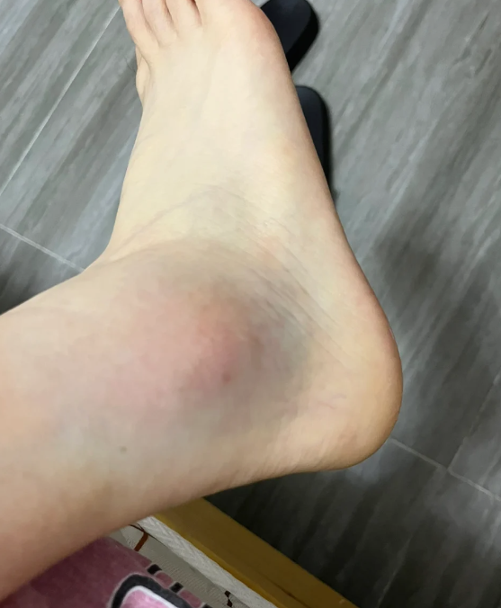 脚扭伤常见原因有摔倒,运动受伤,或者长期穿不合适的鞋走路太多