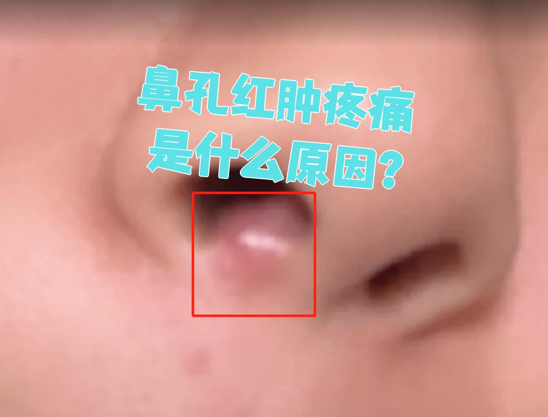 鼻孔红肿疼痛最常见的原因是急性鼻前庭炎,有时也可能是天气寒冷