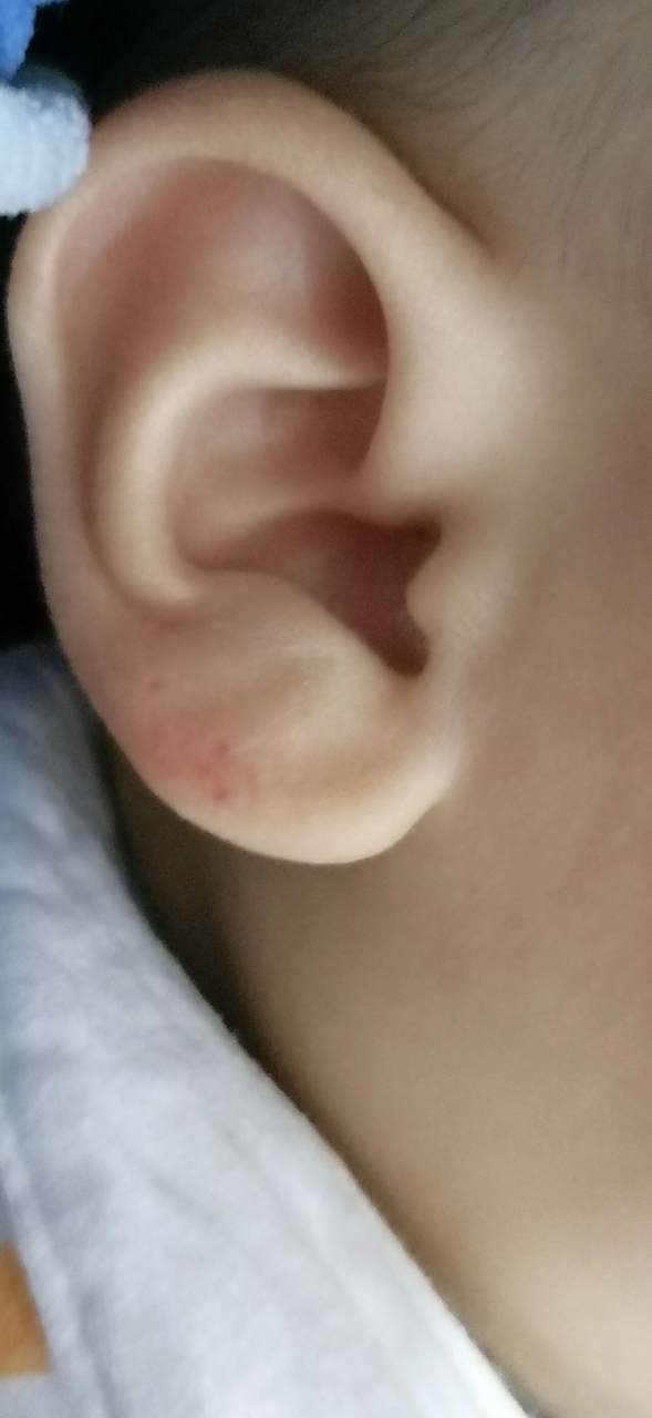 宝宝耳朵突然起了几个红点点 宝宝一夜之间耳朵突然起了这些红点点,有