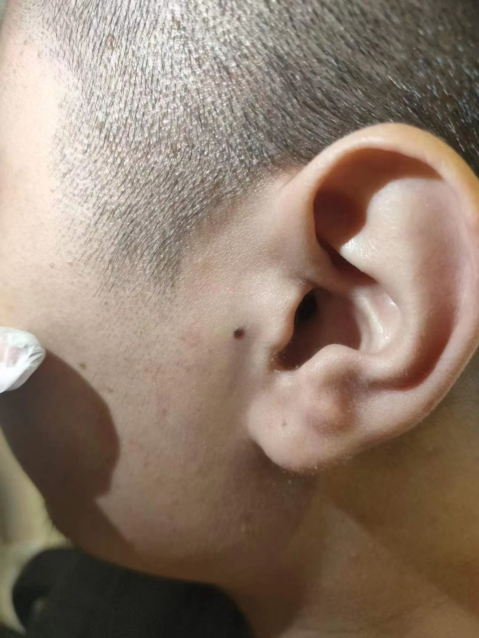 散金痣:也叫穷鬼上门痣 散金痣:也叫穷鬼上门痣点完了相信你的事业