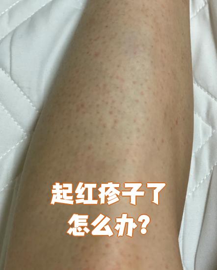 皮肤出现红疹可能是蚊虫叮咬,皮肤过敏或痱子引起的
