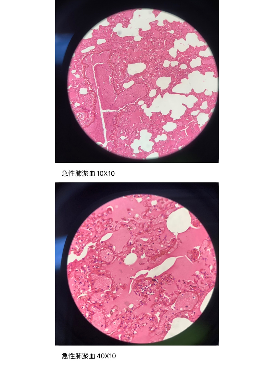 病理学实验报告三 慢性肺淤血