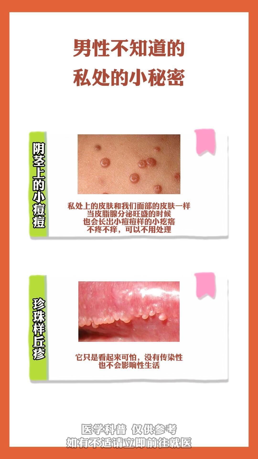 也会长出小痘痘样的小疙瘩 不疼不痒,可以不用处理 第二,阴茎冠状沟