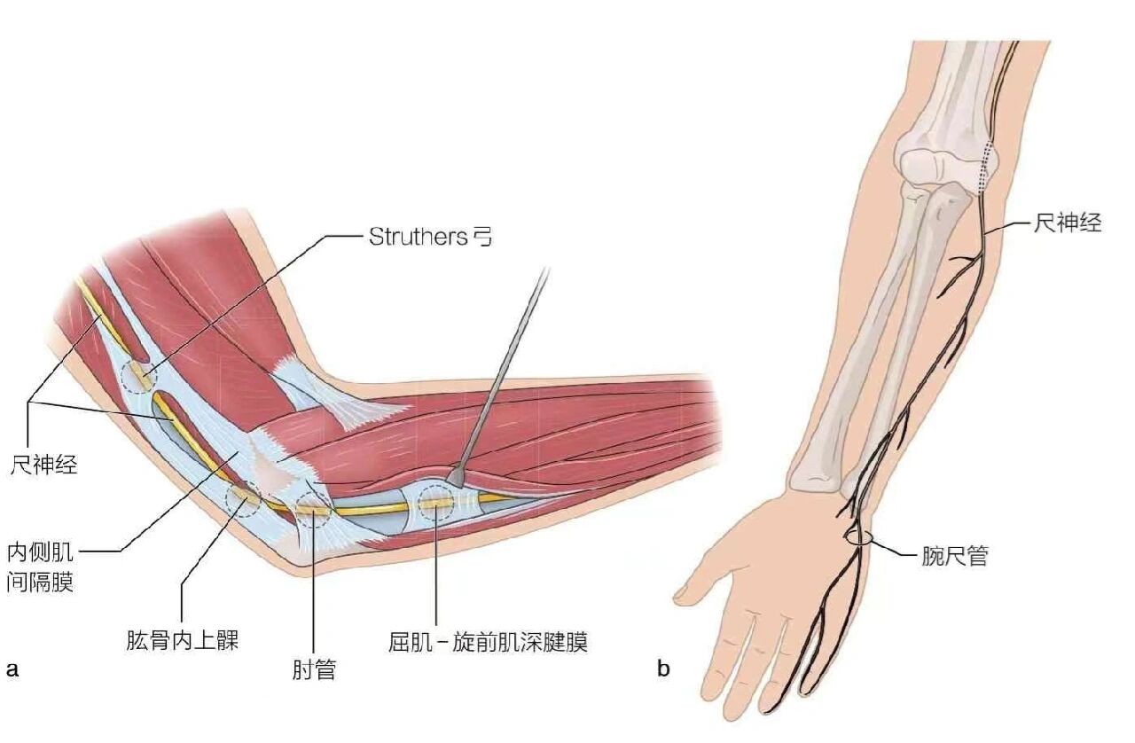 运动康复(肘管综合征)
