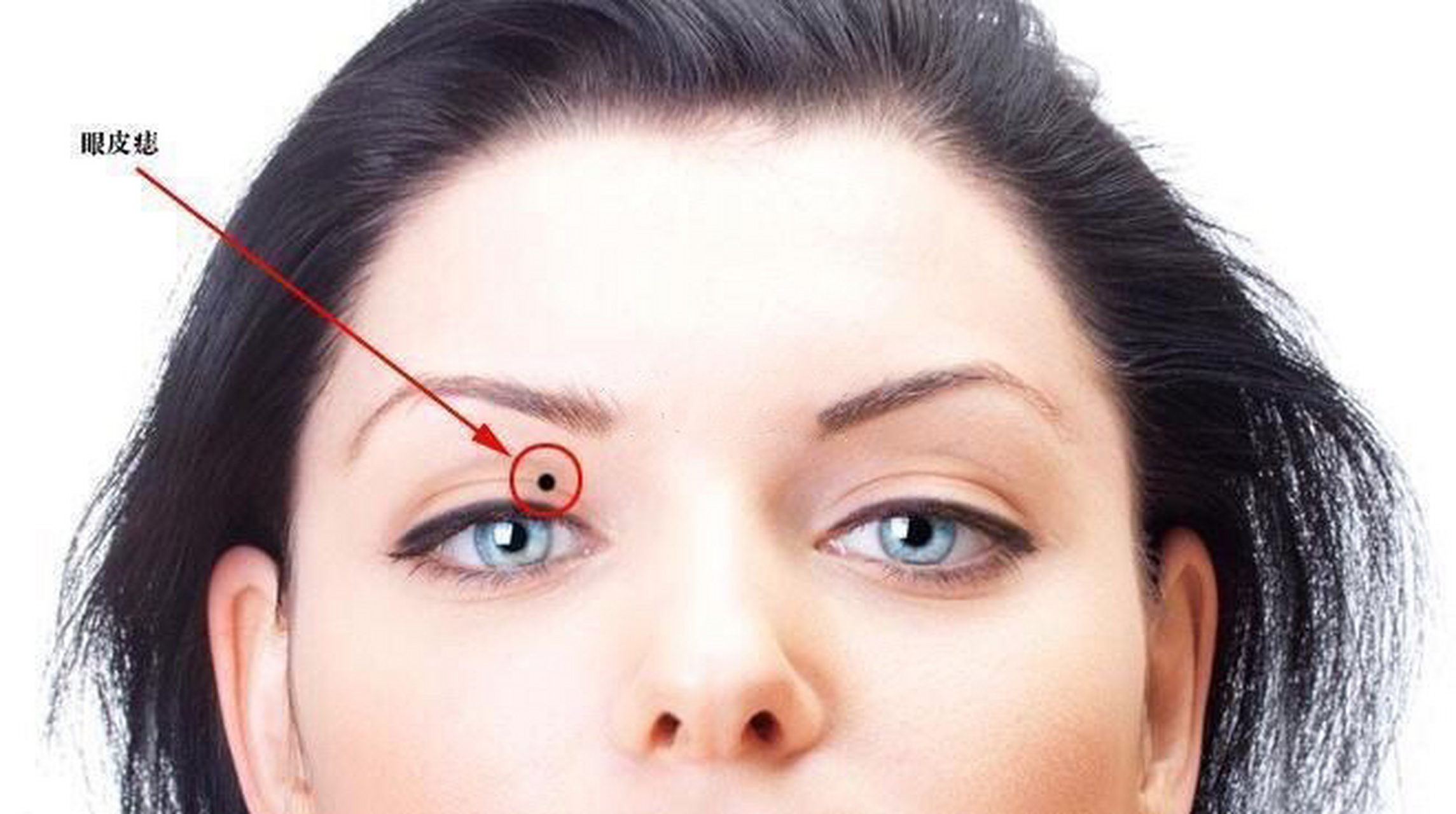 上眼皮有痣是好是坏?