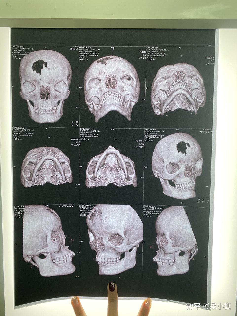 先天颅面畸形女孩让内在美给外在美一个机会