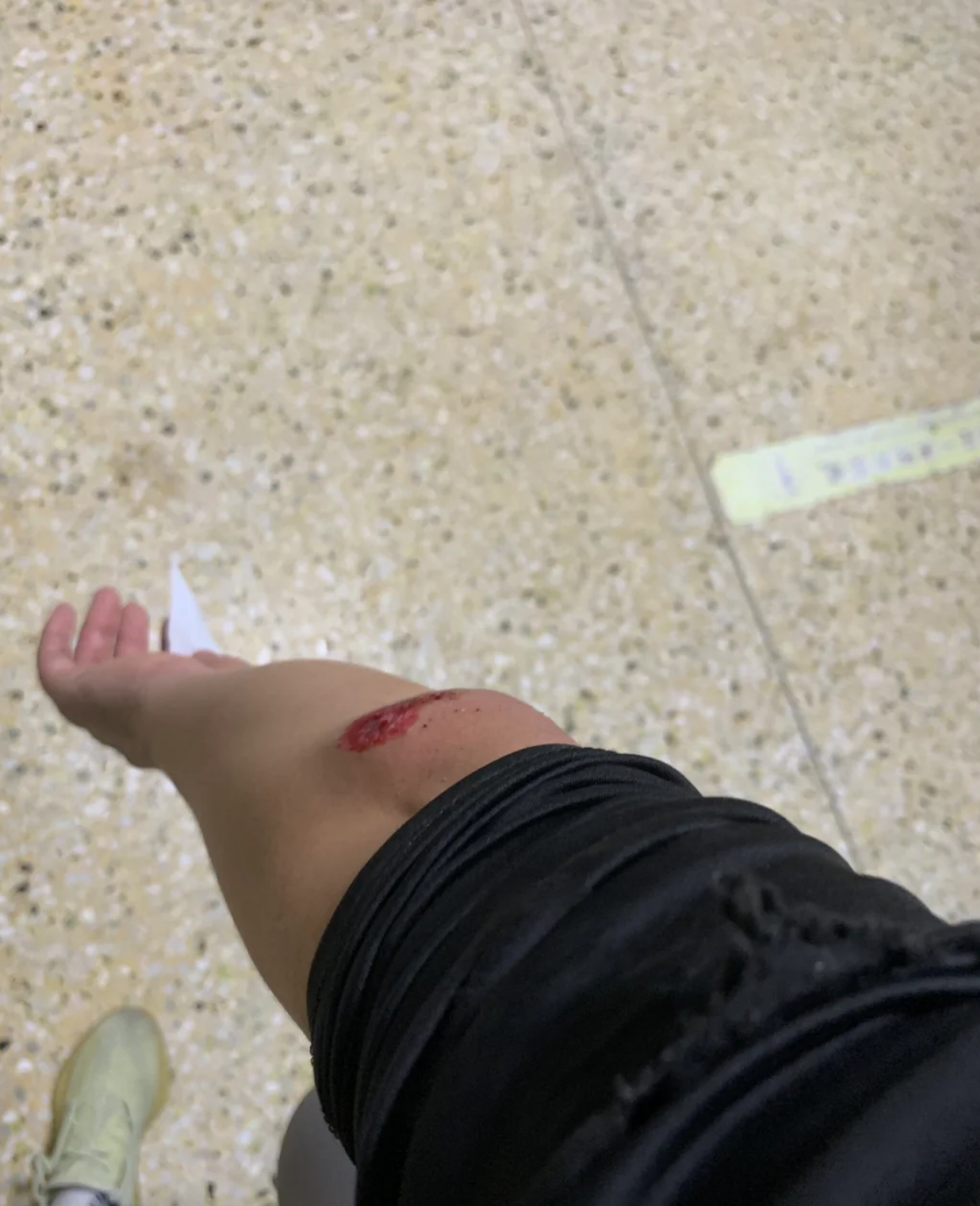 如果胳膊被撞到或者摔伤,可能会伤到骨头或者肌肉,这时候肘关节外侧