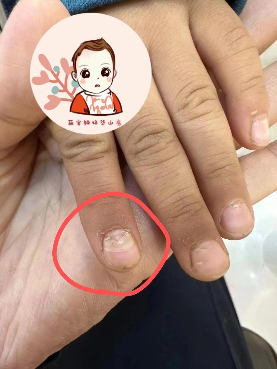 不对,指甲分层断裂,并不是单纯的缺钙～ 告诉你个小秘密,这样的孩子