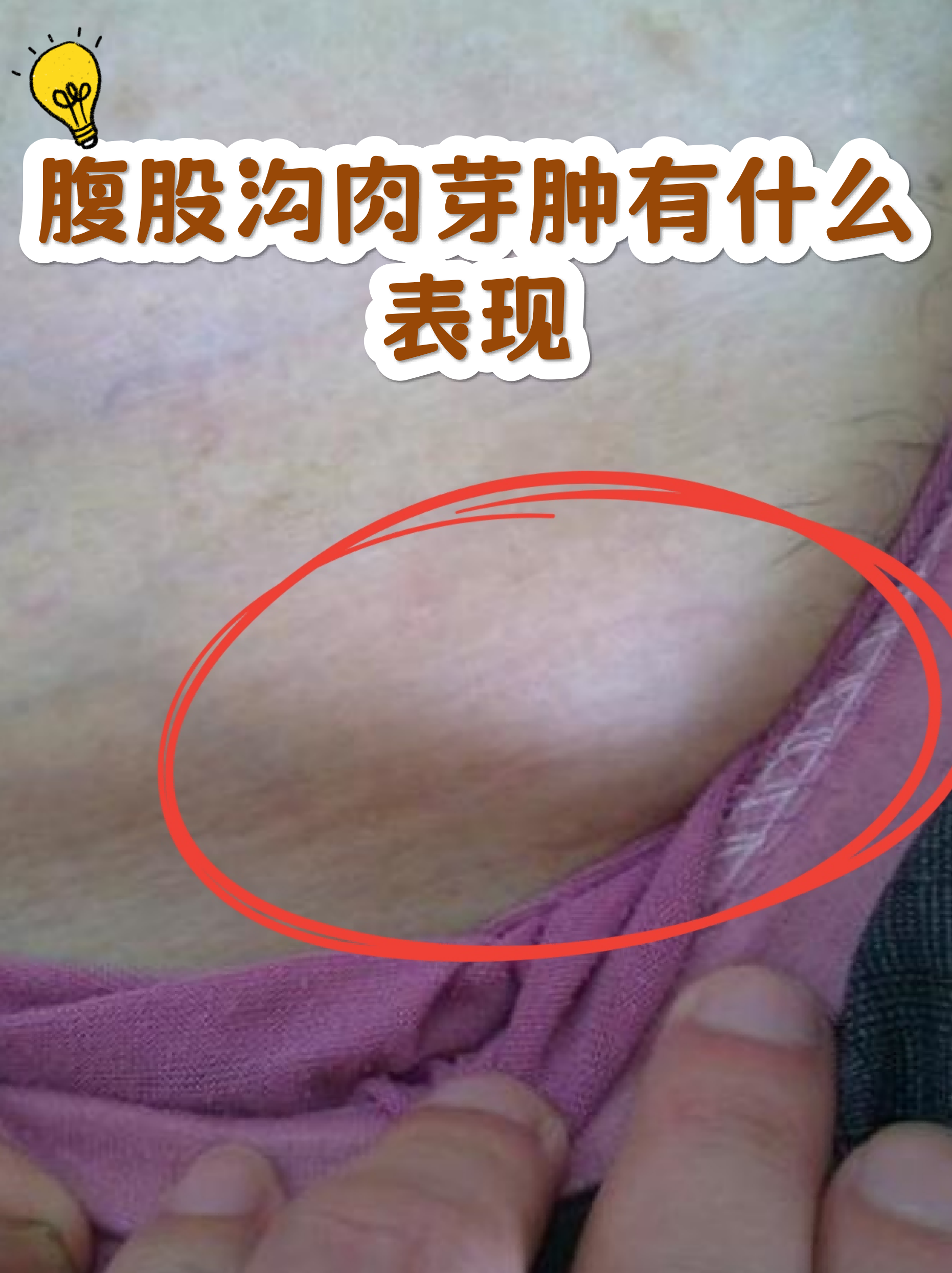 腹股沟肉芽肿有什么表现