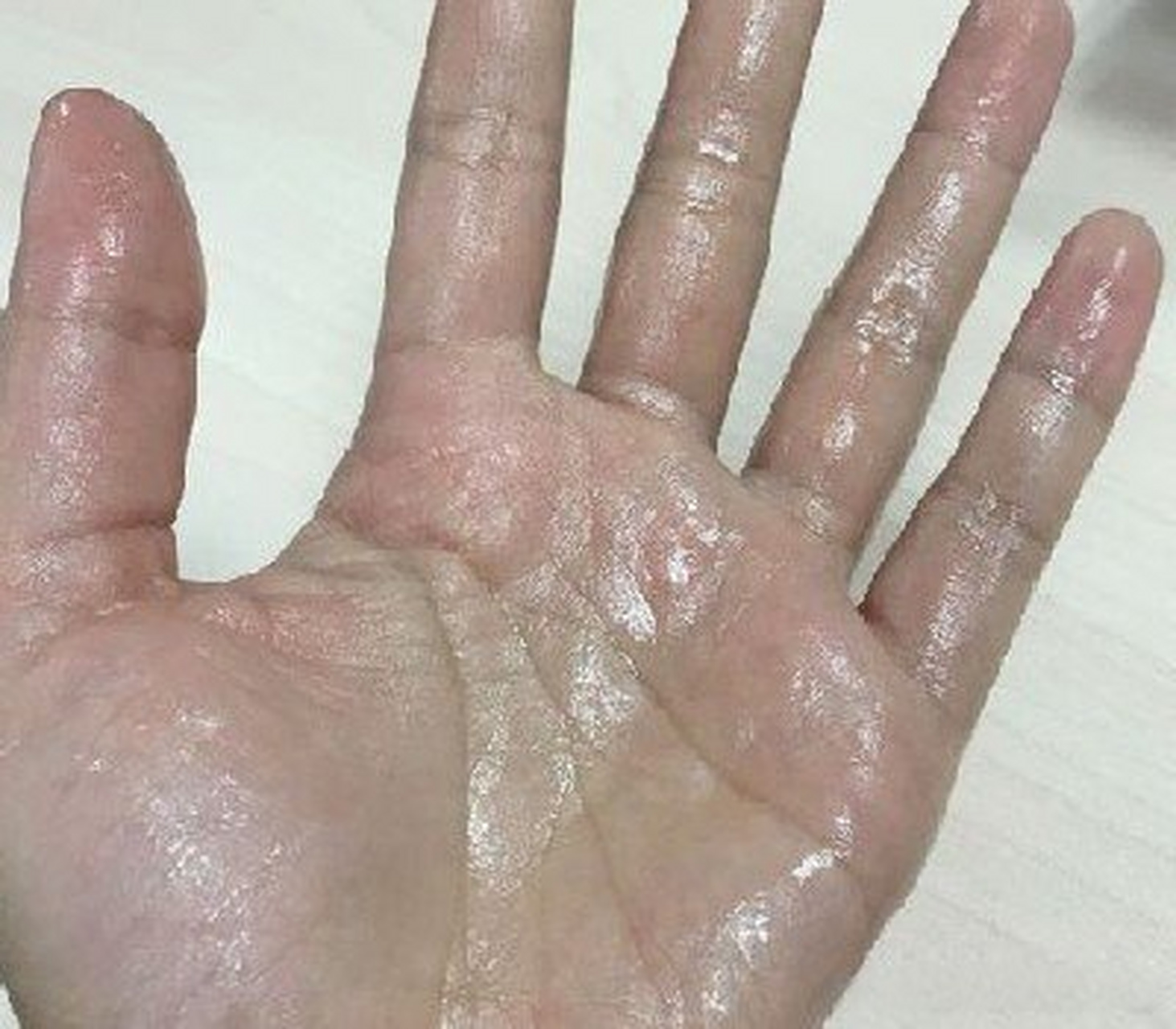 手汗症是怎么回事 一些患者的情绪过于紧张,交感神经就会处在一个亢奋