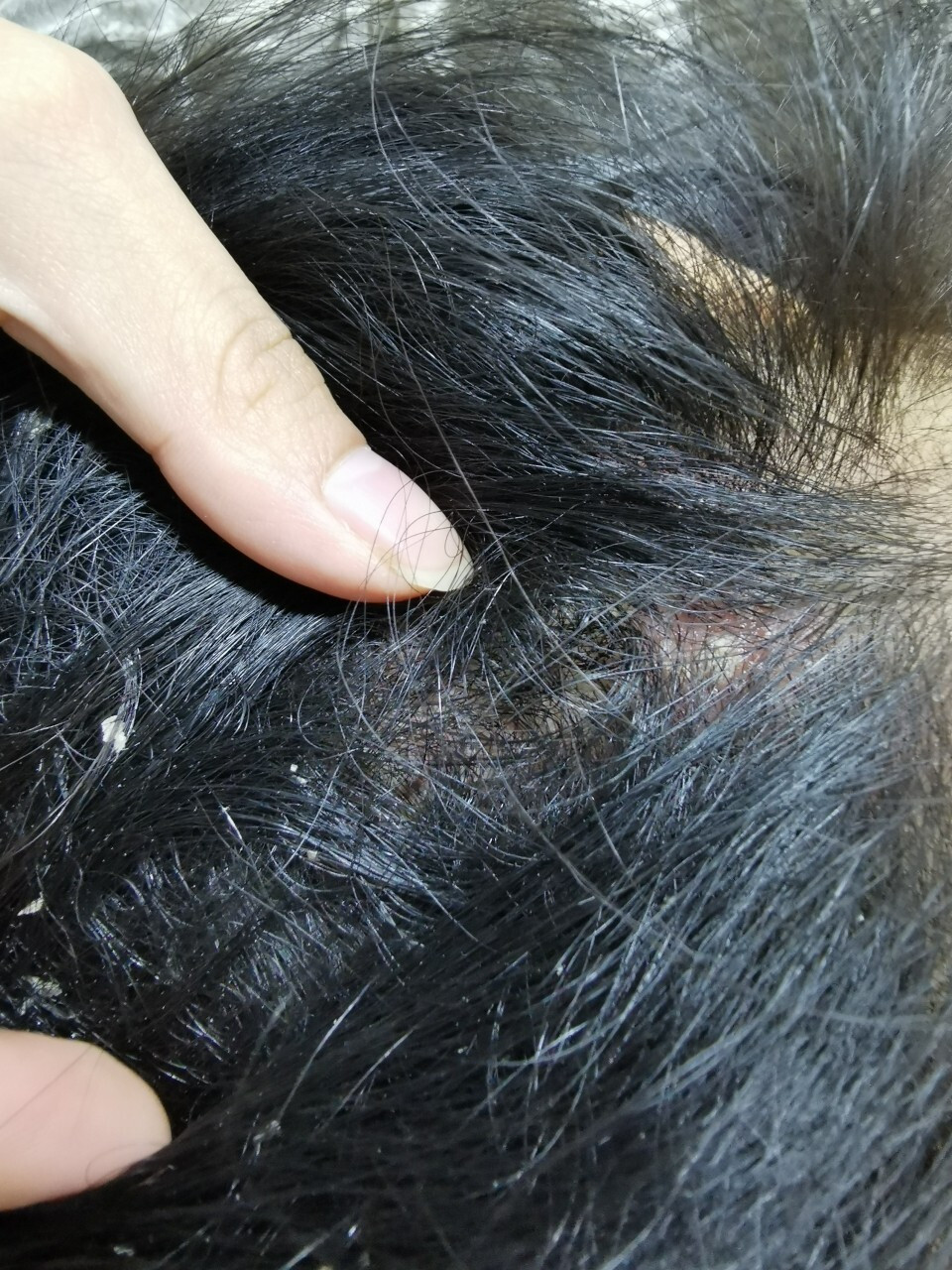 溢脂性皮炎头皮一个患者的自述(不适勿喷) 起初最开始坐月子的时候