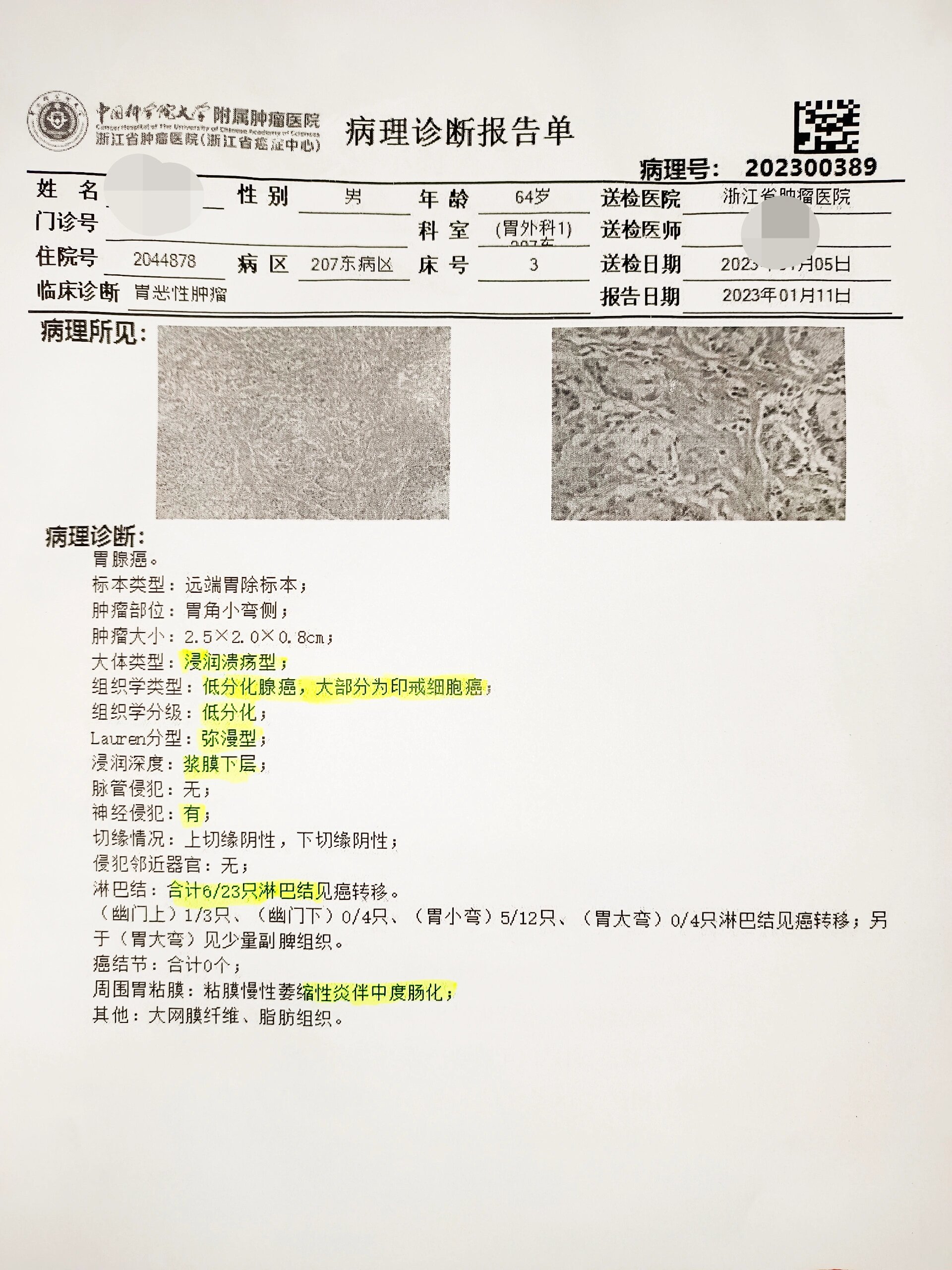 胃角粘膜慢性炎图片