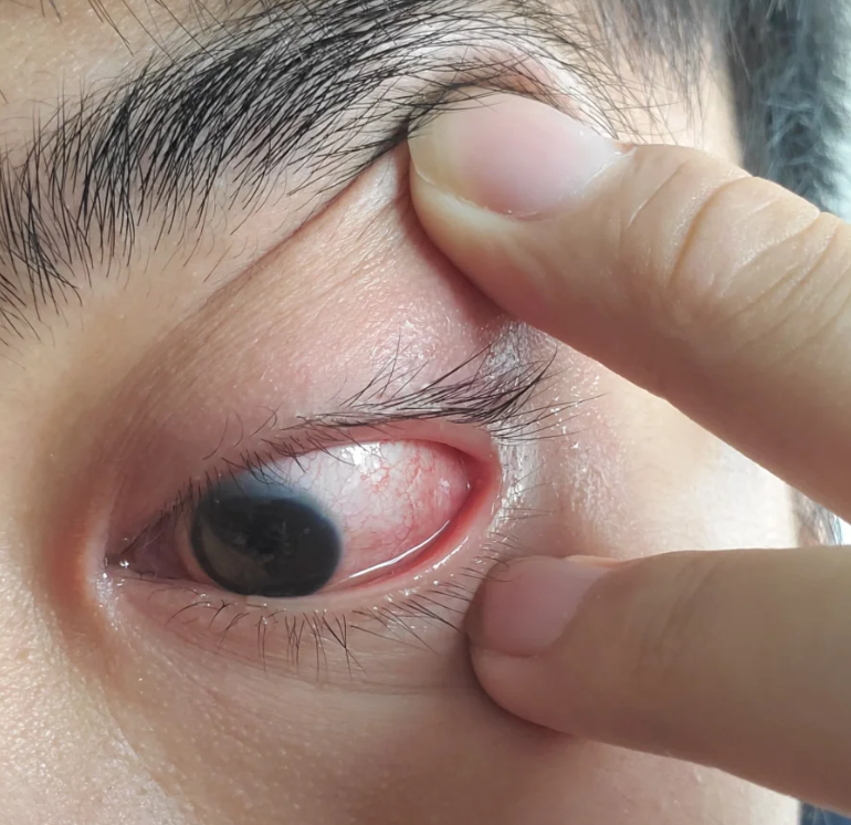 目赤肿痛就是眼睛发红,肿胀和疼痛的意思