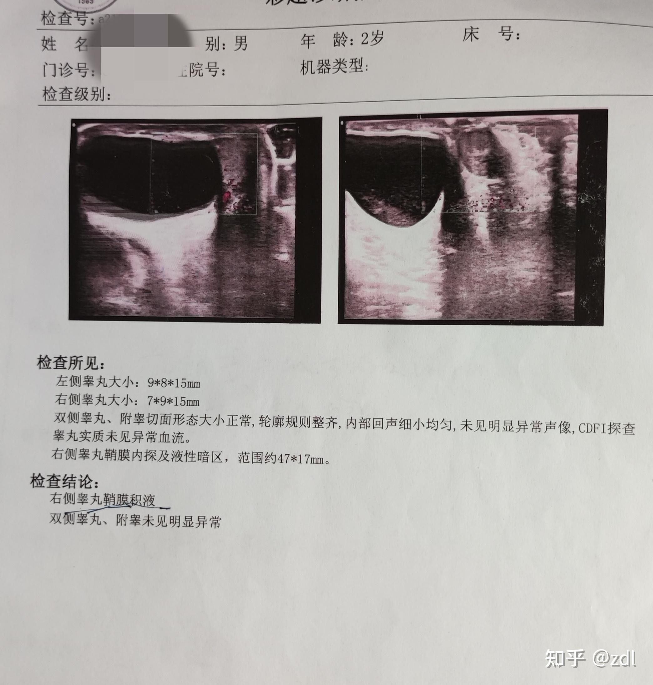 儿童少量鞘膜积液图片图片