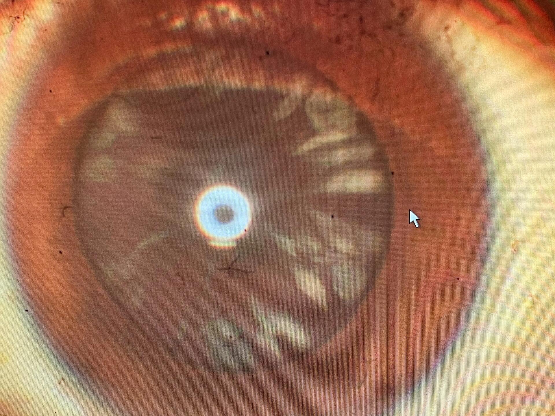 30岁左右白内障一例 照片分别为右眼和左眼的前节照相,可见晶状体较为