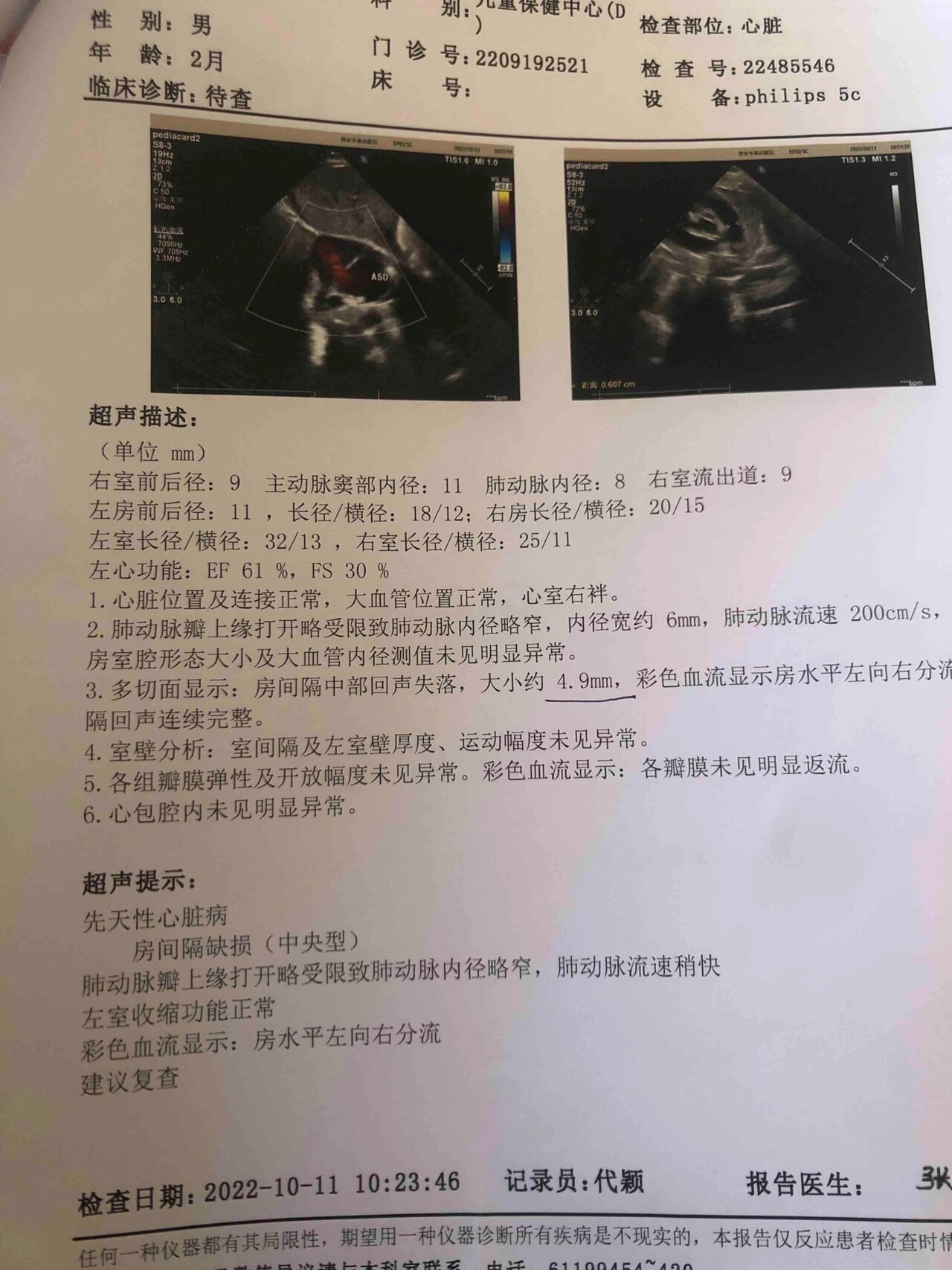 先天性心脏病房间隔缺损