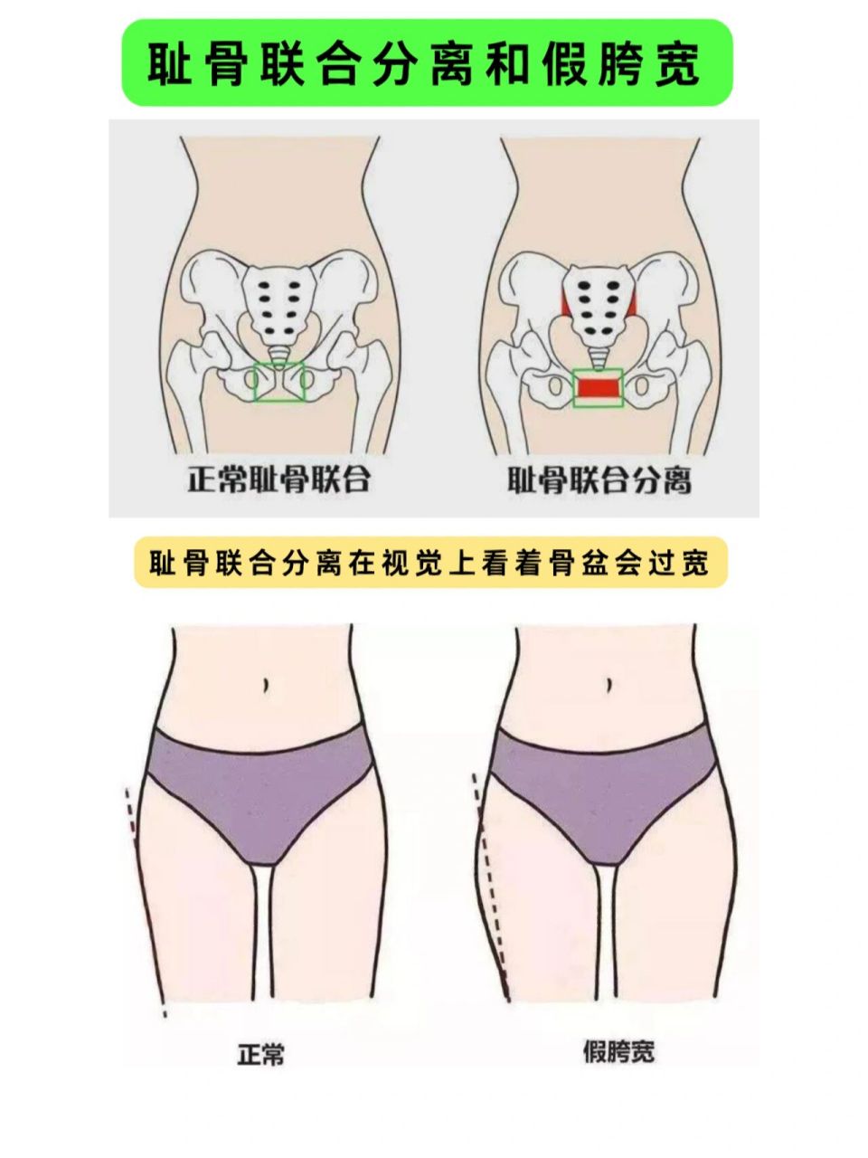 假胯宽是指在大腿根儿外侧,突出起来,显得很宽.