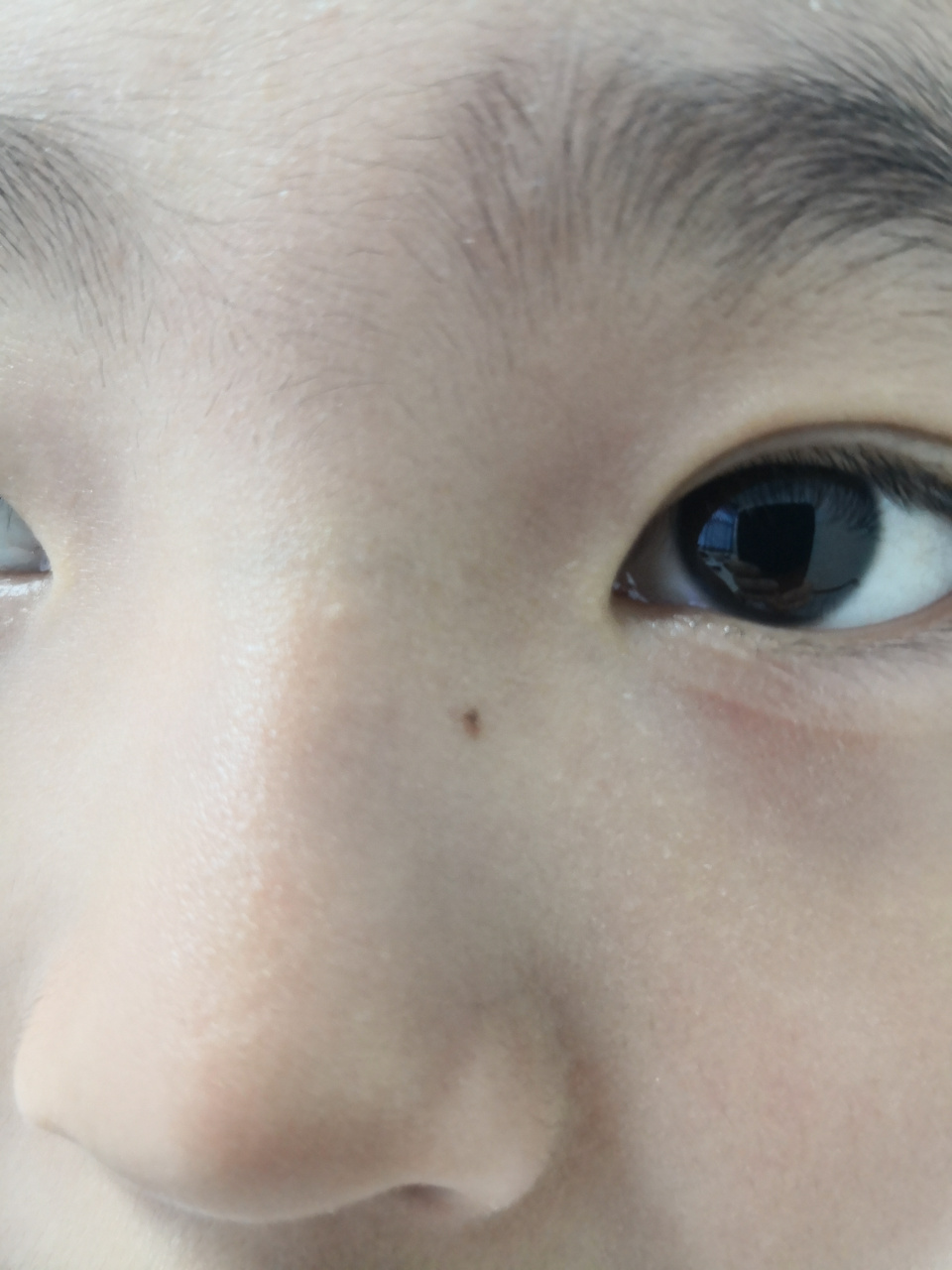 儿童面部色素痣症状.可以使用激光治疗去除.操作简单方便效果可靠.