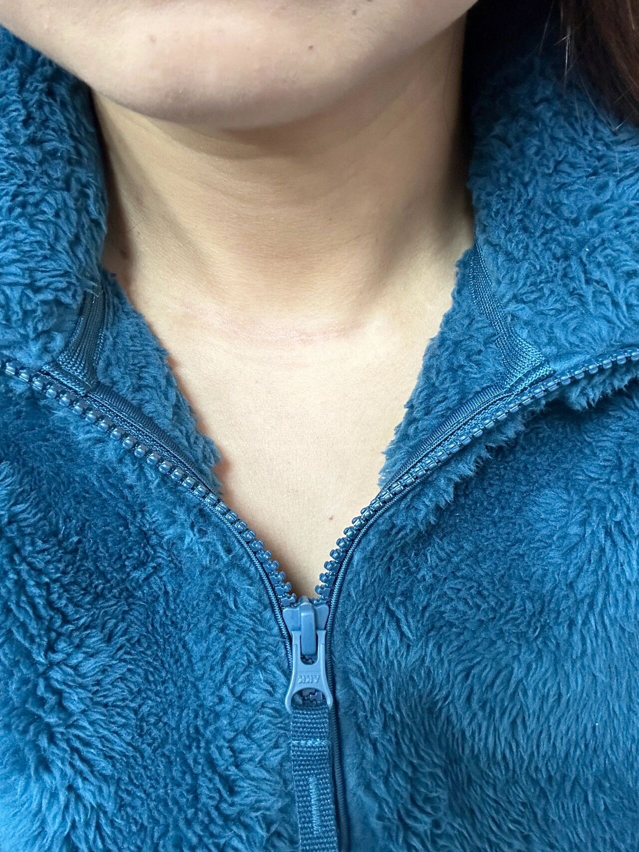 甲状腺癌手术后 今天手术后整一年,记录疤痕恢复