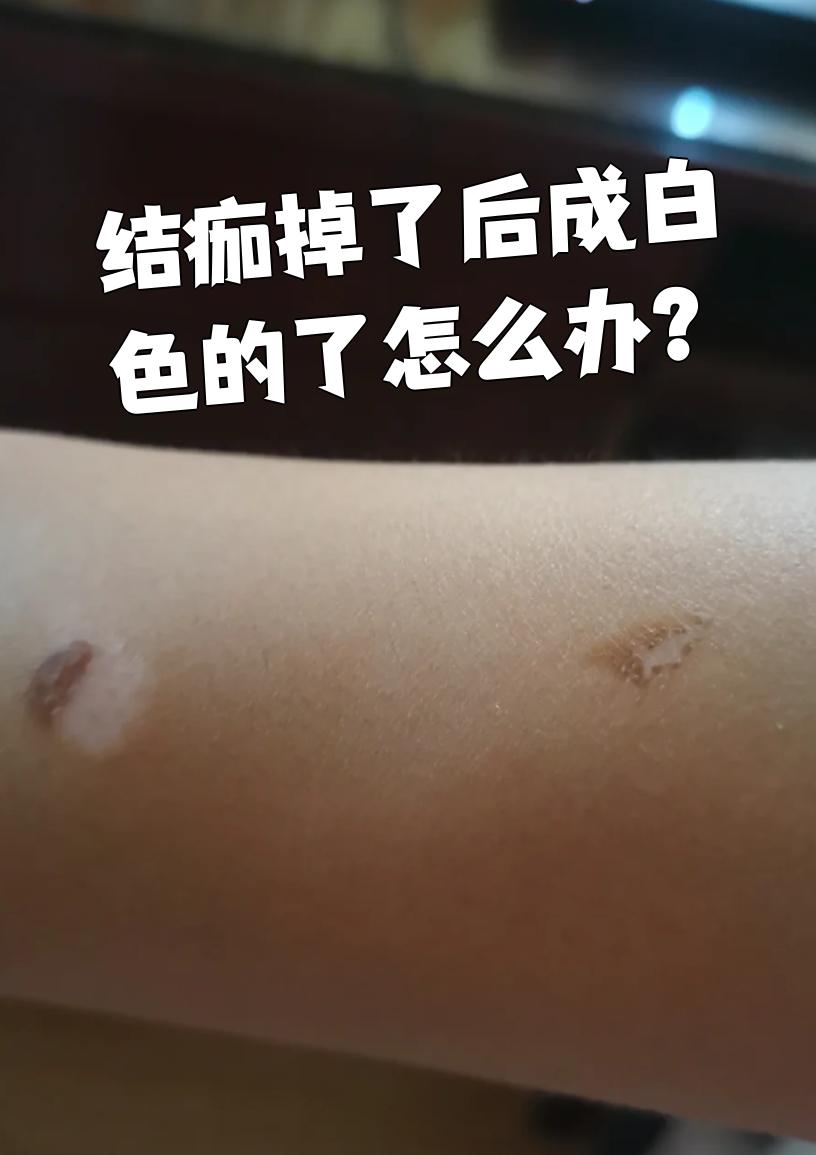 结痂掉了后皮肤变白,可能是湿疹或银屑病引起的