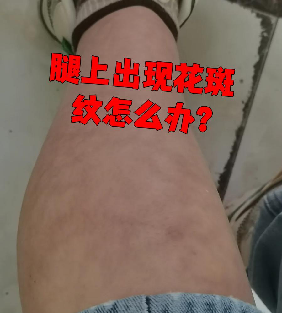如果是网状青斑,皮肤会出现青紫色或红色的网状斑纹,可能伴有轻度