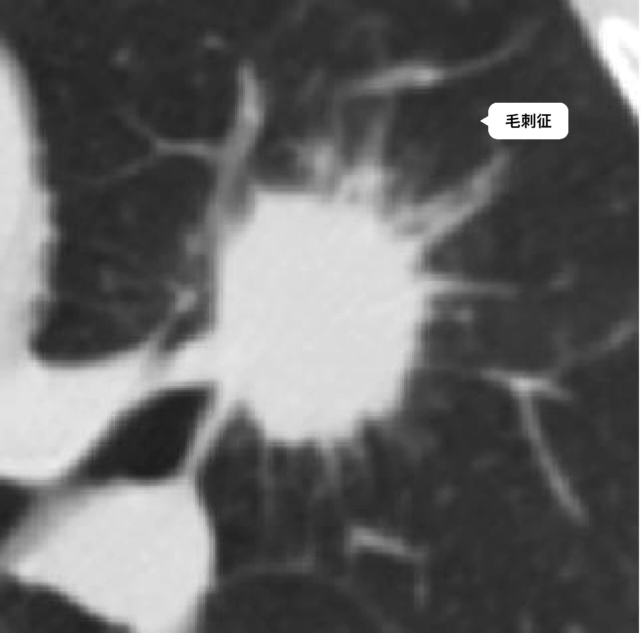 周围型肺腺癌典型影像学征象(一) 肺腺癌典型征象分叶征,毛刺征,支