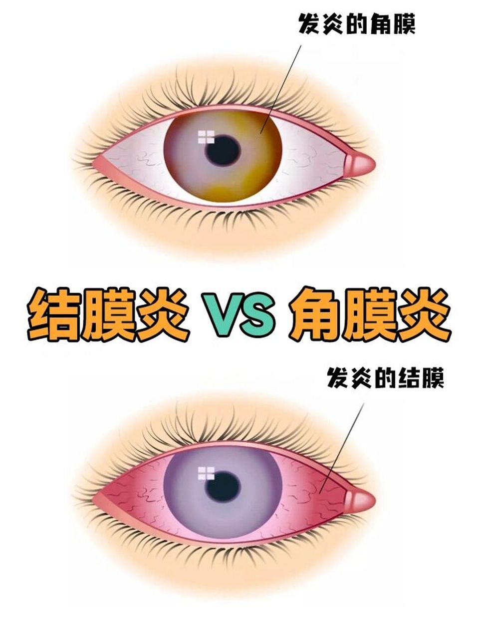 7215其中角膜炎发生在眼睛的黑眼球部位;而结膜炎发生在眼睛的白