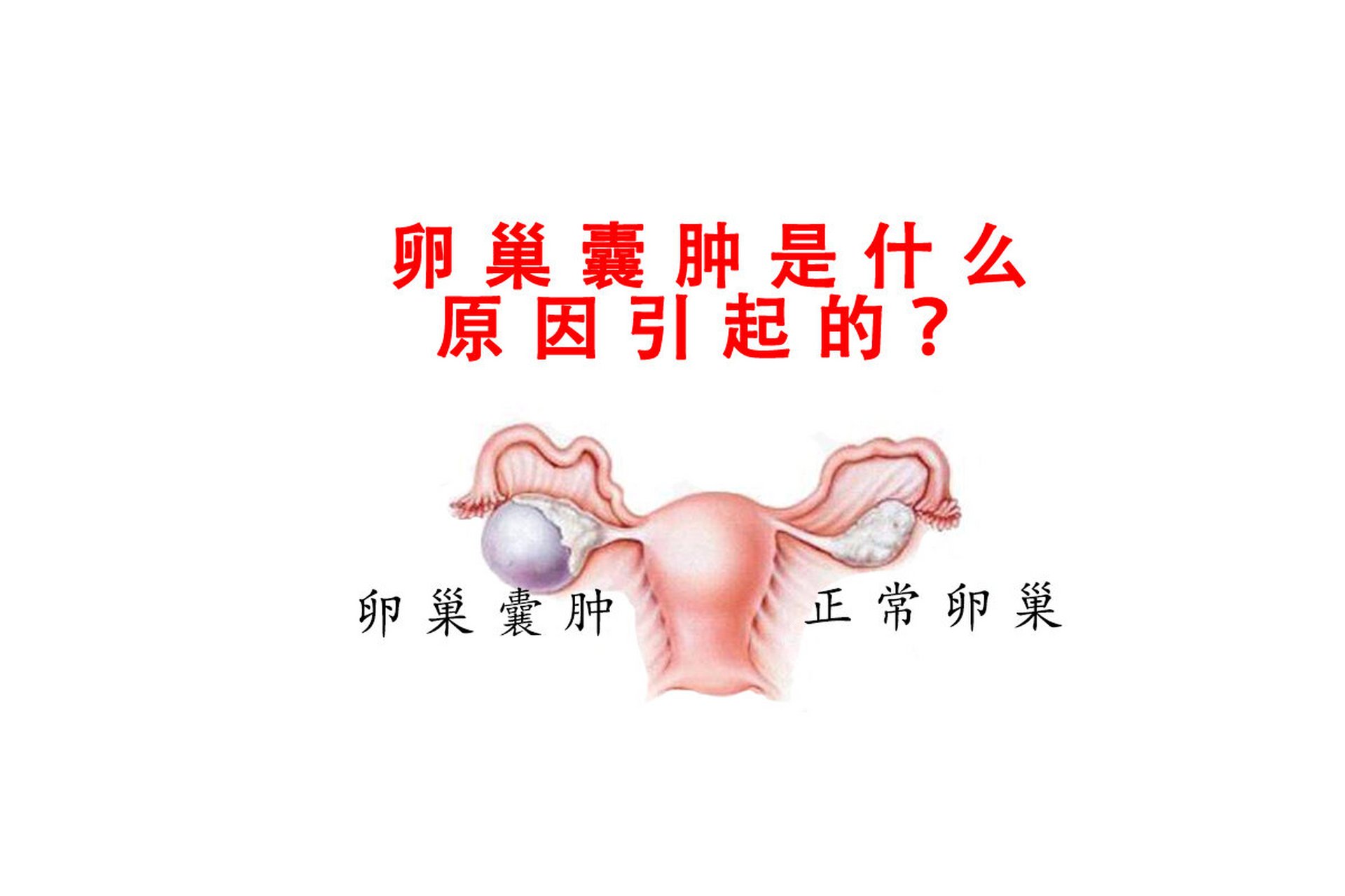 卵巢囊肿的原因如下: 1,生理性囊肿:就是在排卵过程中可能残存卵琶换
