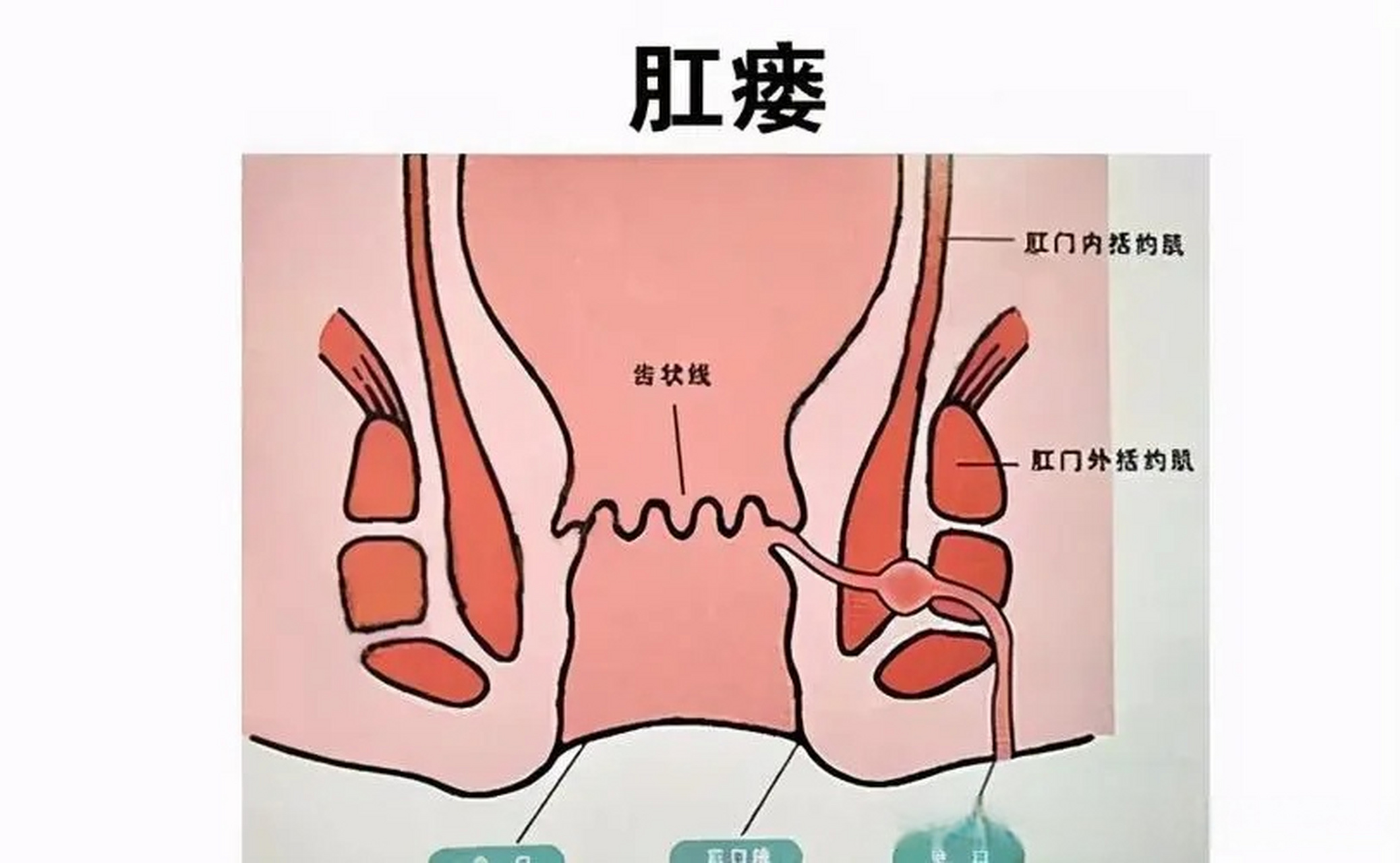 肛漏 原因图片